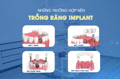 TRỒNG RĂNG IMPLANT - PHƯƠNG PHÁP HIỆU QUẢ KHÔI PHỤC HÀM RĂNG VÀ NỤ CƯỜI TỰ TIN
